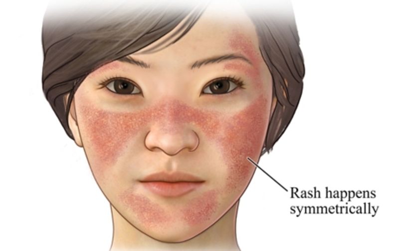 Lupus Facial Rash